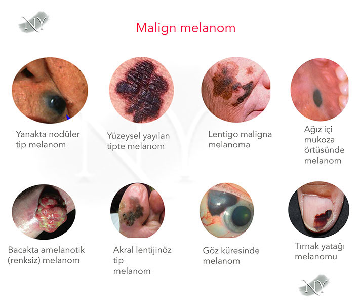 Melanom (Malign Melanom)