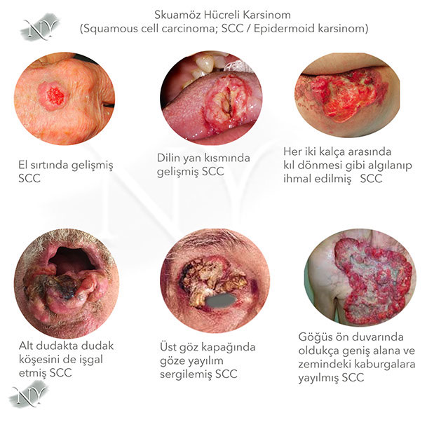 Skuamöz Hücreli Korsinom Alt Tipleri